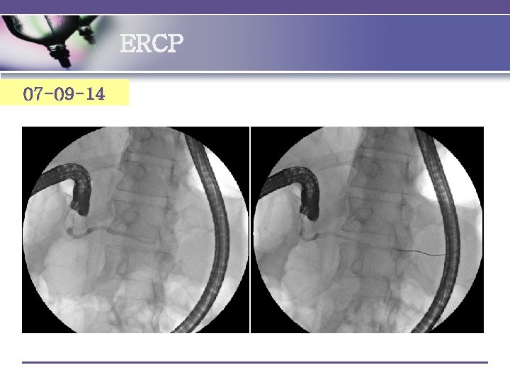ERCP 07 -09 -14 