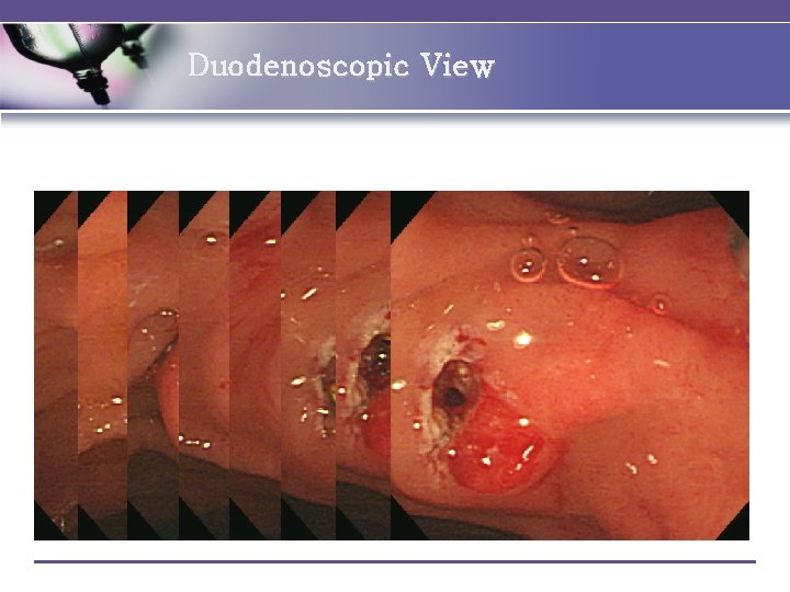 Duodenoscopic View 