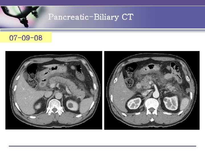 Pancreatic-Biliary CT 07 -09 -08 
