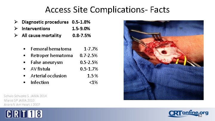 Access Site Complications- Facts Ø Diagnostic procedures 0. 5 -1. 8% Ø Interventions 1.