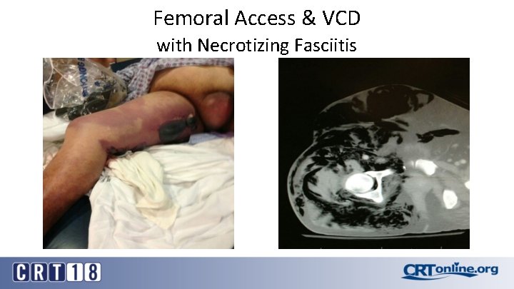 Femoral Access & VCD with Necrotizing Fasciitis 