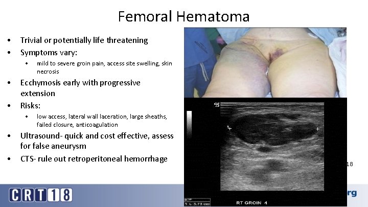 Femoral Hematoma • • Trivial or potentially life threatening Symptoms vary: • • •