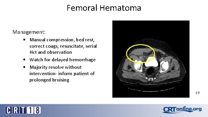 Femoral Hematoma Management: • Manual compression, bed rest, correct coags, resuscitate, serial Hct and