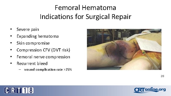 Femoral Hematoma Indications for Surgical Repair • • • Severe pain Expanding hematoma Skin