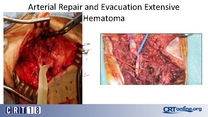 Arterial Repair and Evacuation Extensive Hematoma 21 