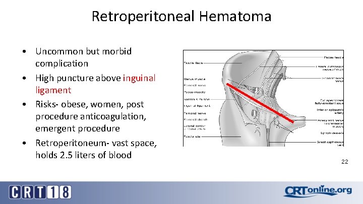Retroperitoneal Hematoma • Uncommon but morbid complication • High puncture above inguinal ligament •