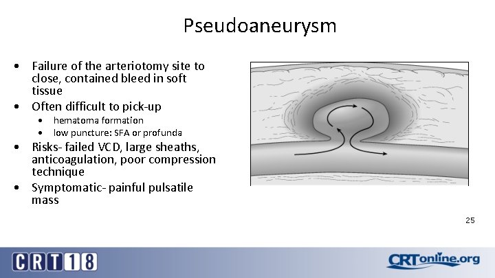 Pseudoaneurysm • Failure of the arteriotomy site to close, contained bleed in soft tissue