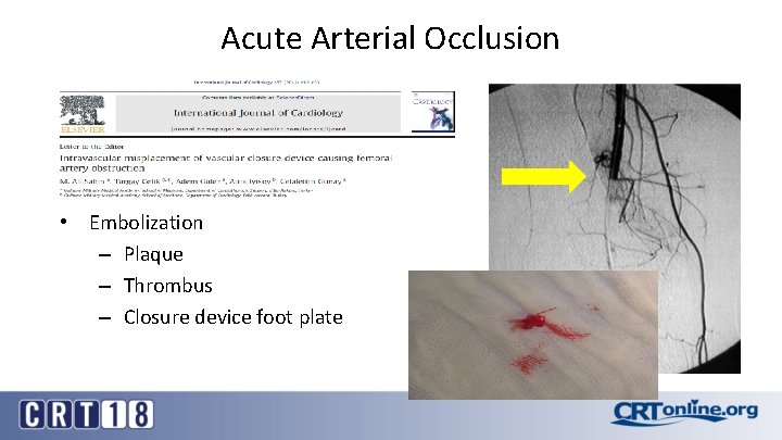 Acute Arterial Occlusion • Embolization – Plaque – Thrombus – Closure device foot plate