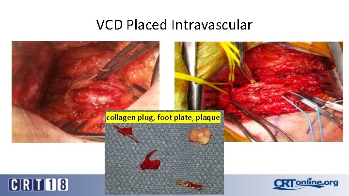 VCD Placed Intravascular collagen plug, foot plate, plaque 