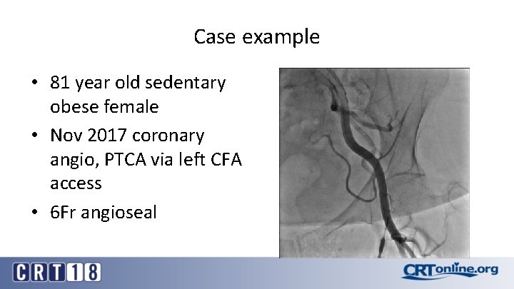 Case example • 81 year old sedentary obese female • Nov 2017 coronary angio,