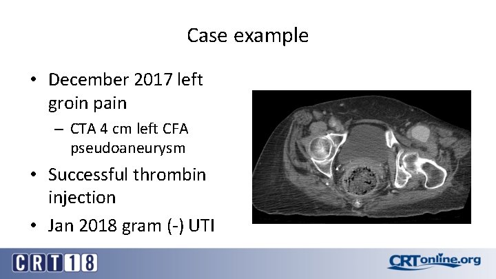 Case example • December 2017 left groin pain – CTA 4 cm left CFA