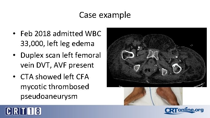 Case example • Feb 2018 admitted WBC 33, 000, left leg edema • Duplex
