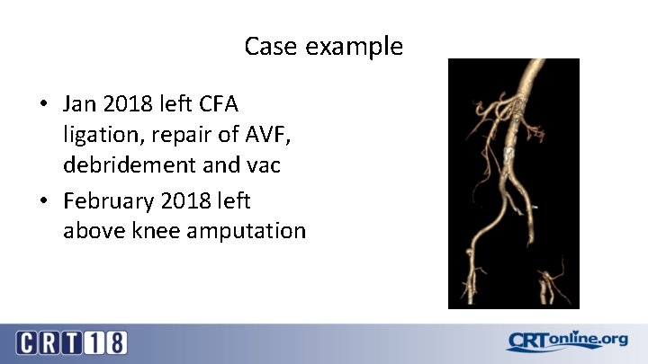 Case example • Jan 2018 left CFA ligation, repair of AVF, debridement and vac