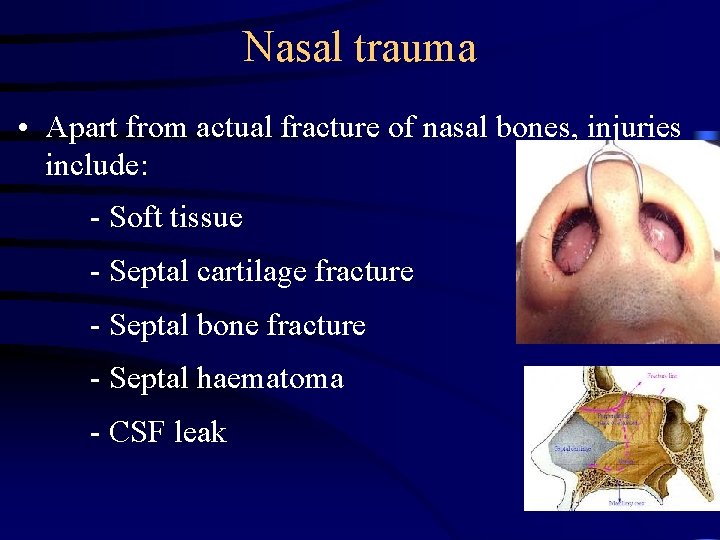 Nasal trauma • Apart from actual fracture of nasal bones, injuries include: - Soft