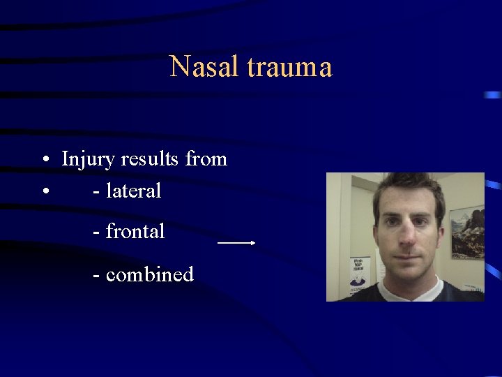 Nasal trauma • Injury results from • - lateral - frontal - combined 