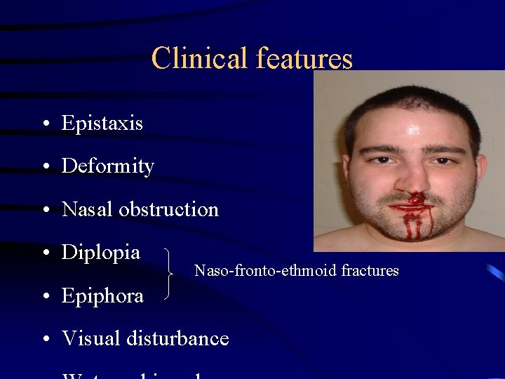 Clinical features • Epistaxis • Deformity • Nasal obstruction • Diplopia Naso-fronto-ethmoid fractures •