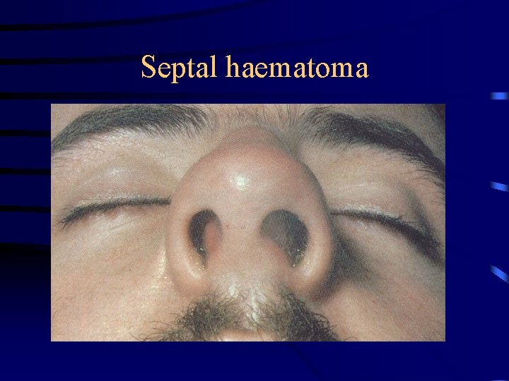 Septal haematoma 