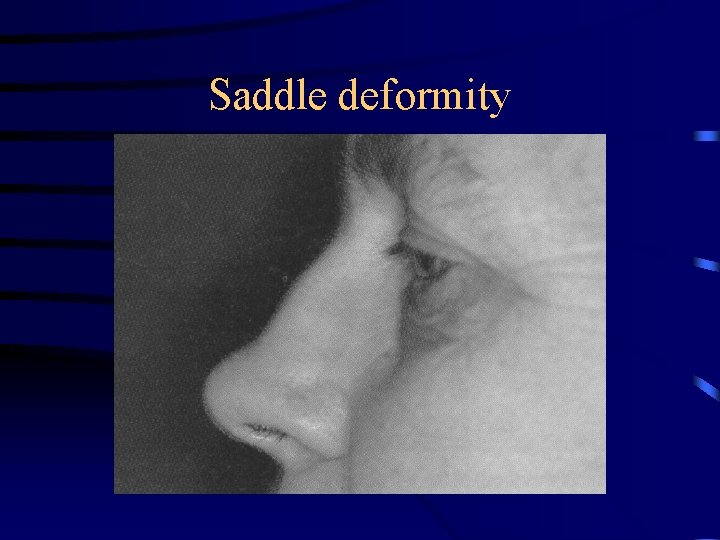 Saddle deformity 