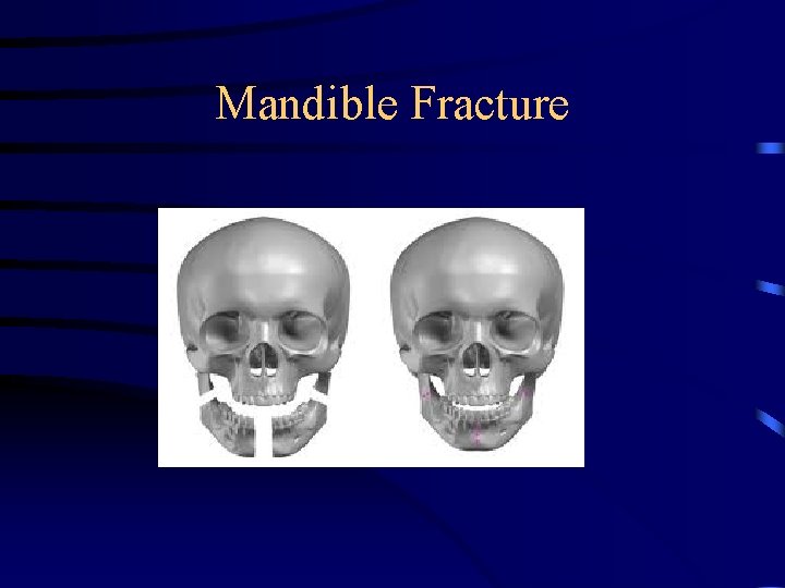 Mandible Fracture 