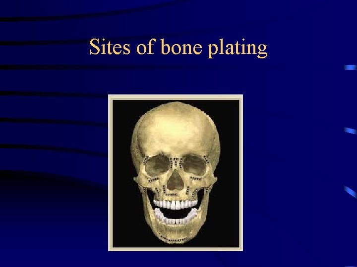 Sites of bone plating 