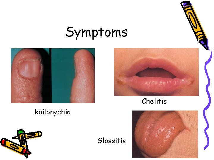 Symptoms Chelitis koilonychia Glossitis 