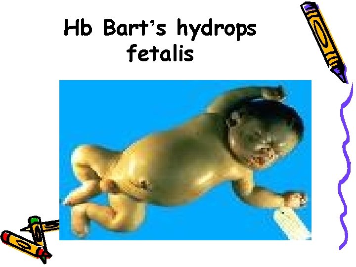 Hb Bart’s hydrops fetalis 