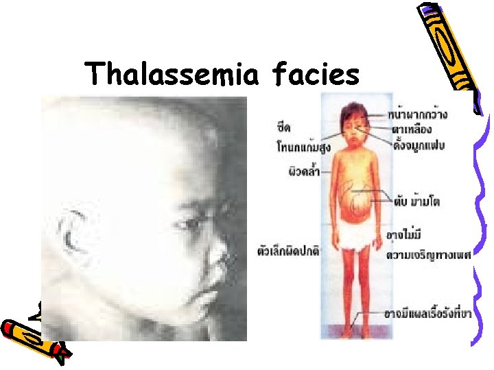 Thalassemia facies 