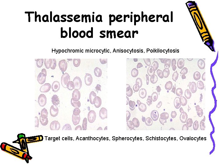 Thalassemia peripheral blood smear Hypochromic microcytic, Anisocytosis, Poikilocytosis Target cells, Acanthocytes, Spherocytes, Schistocytes, Ovalocytes