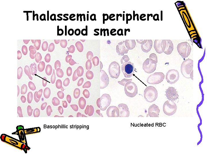 Thalassemia peripheral blood smear Basophillic stripping Nucleated RBC 