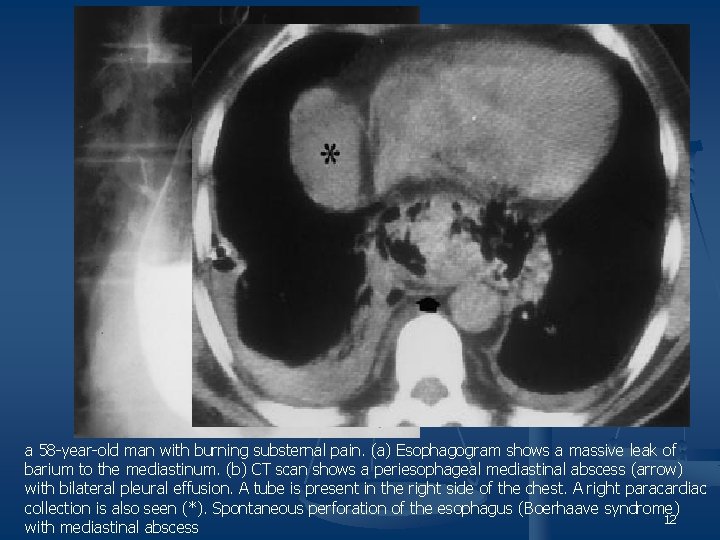 a 58 -year-old man with burning substernal pain. (a) Esophagogram shows a massive leak