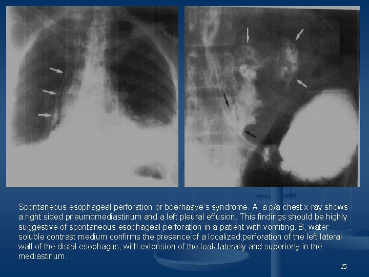 Spontaneous esophageal perforation or boerhaave’s syndrome. A a p/a chest x ray shows a