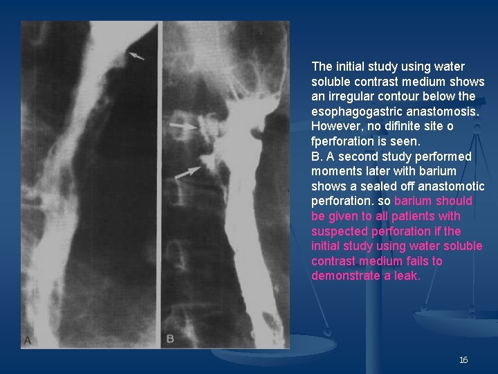 The initial study using water soluble contrast medium shows an irregular contour below the