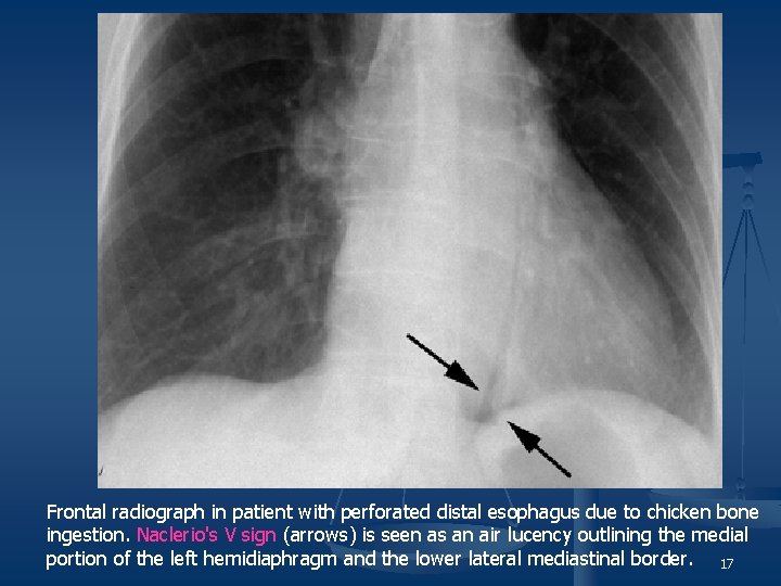 Frontal radiograph in patient with perforated distal esophagus due to chicken bone ingestion. Naclerio's