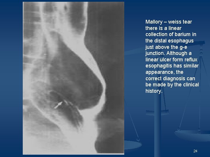Mallory – weiss tear there is a linear collection of barium in the distal
