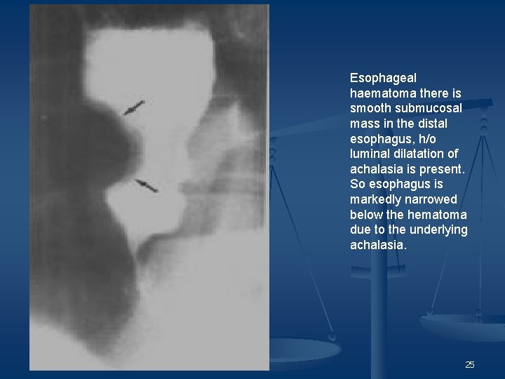 Esophageal haematoma there is smooth submucosal mass in the distal esophagus, h/o luminal dilatation