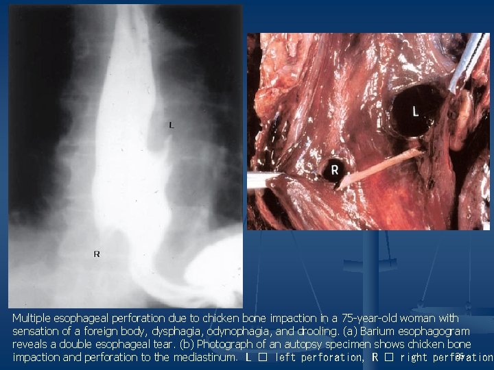 Multiple esophageal perforation due to chicken bone impaction in a 75 -year-old woman with