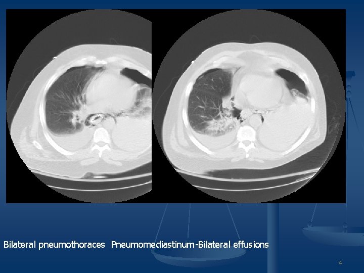 Bilateral pneumothoraces Pneumomediastinum-Bilateral effusions 4 