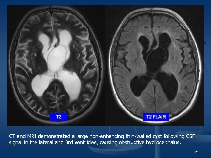 CT and MRI demonstrated a large non-enhancing thin-walled cyst following CSF signal in the