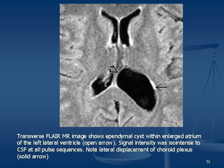 Transverse FLAIR MR image shows ependymal cyst within enlarged atrium of the left lateral