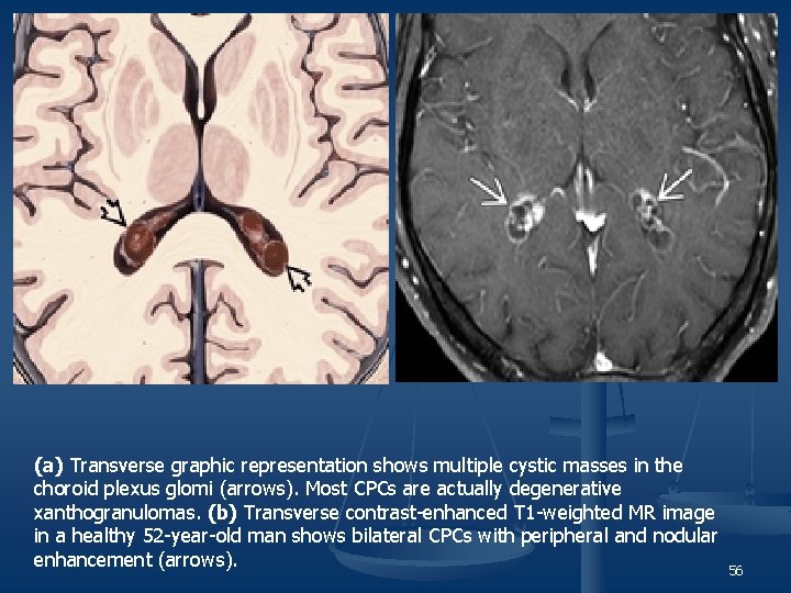 (a) Transverse graphic representation shows multiple cystic masses in the choroid plexus glomi (arrows).