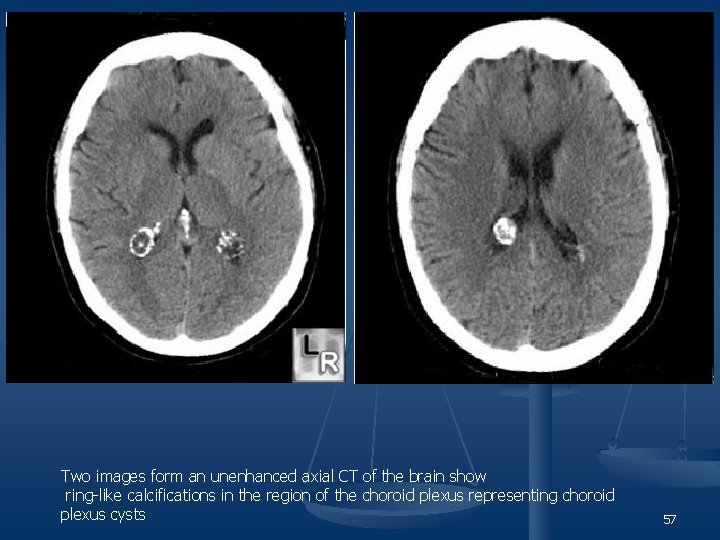 Two images form an unenhanced axial CT of the brain show ring-like calcifications in