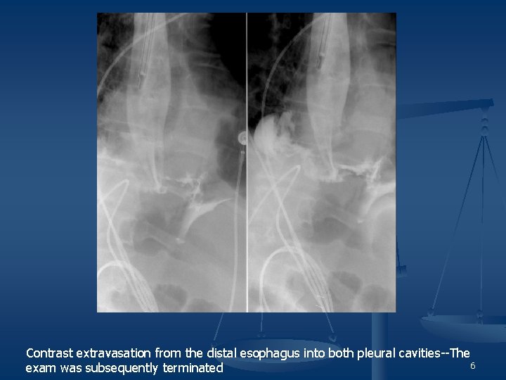 Contrast extravasation from the distal esophagus into both pleural cavities--The 6 exam was subsequently