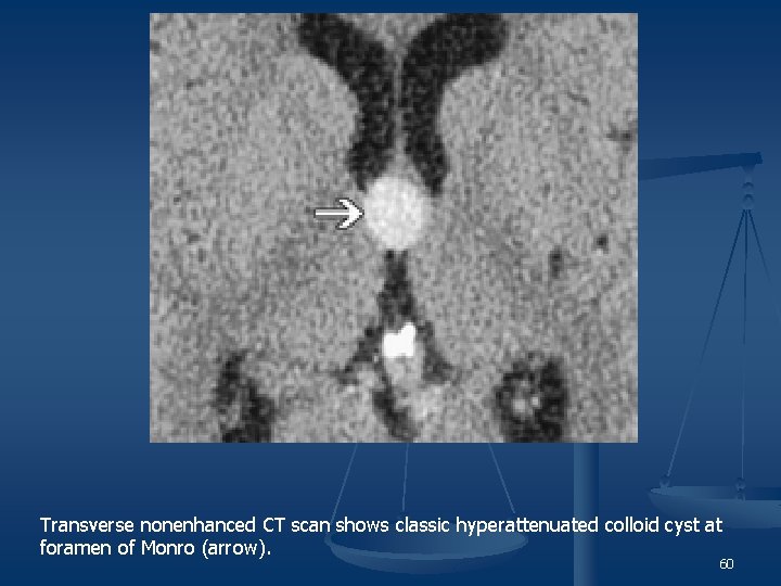 Transverse nonenhanced CT scan shows classic hyperattenuated colloid cyst at foramen of Monro (arrow).