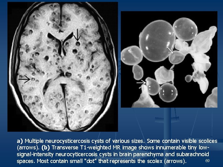 a) Multiple neurocysticercosis cysts of various sizes. Some contain visible scolices (arrows). (b) Transverse