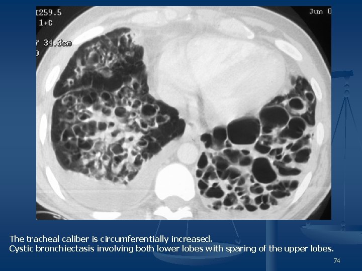 The tracheal caliber is circumferentially increased. Cystic bronchiectasis involving both lower lobes with sparing