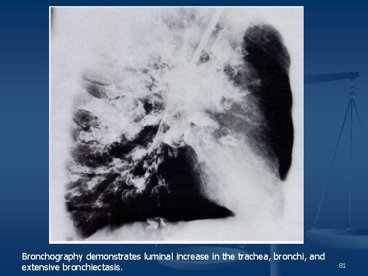 Bronchography demonstrates luminal increase in the trachea, bronchi, and extensive bronchiectasis. 81 