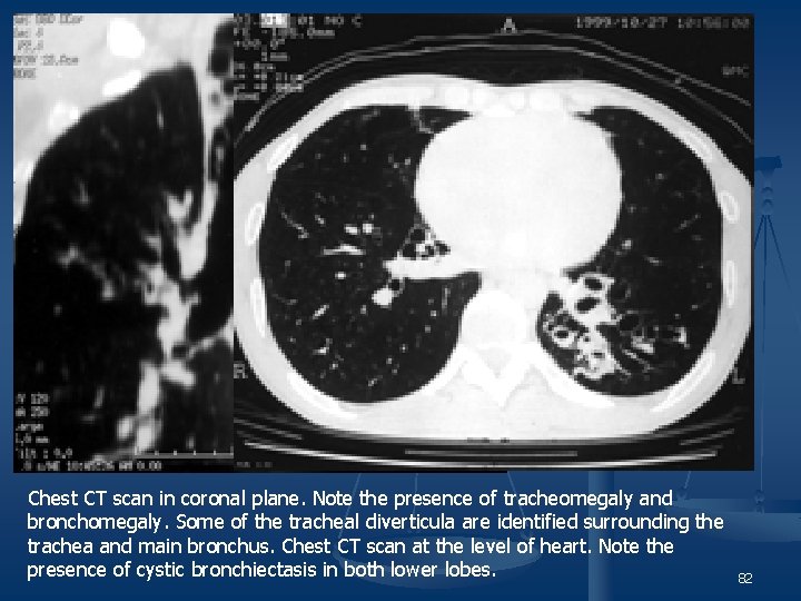 Chest CT scan in coronal plane. Note the presence of tracheomegaly and bronchomegaly. Some