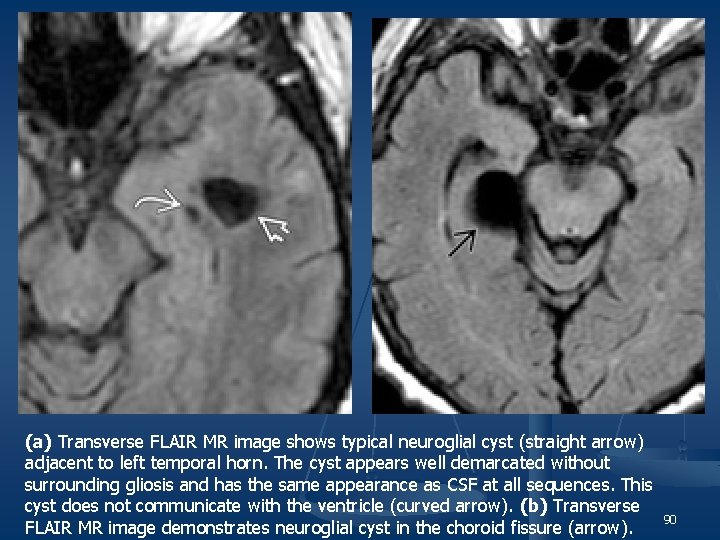 (a) Transverse FLAIR MR image shows typical neuroglial cyst (straight arrow) adjacent to left