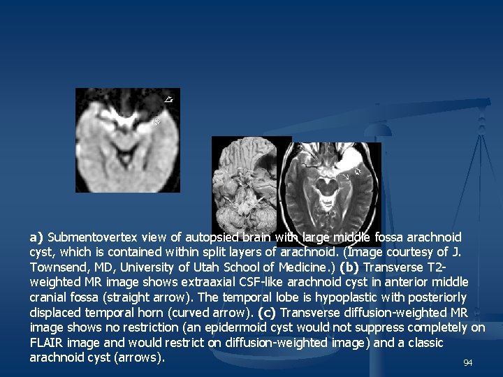 a) Submentovertex view of autopsied brain with large middle fossa arachnoid cyst, which is