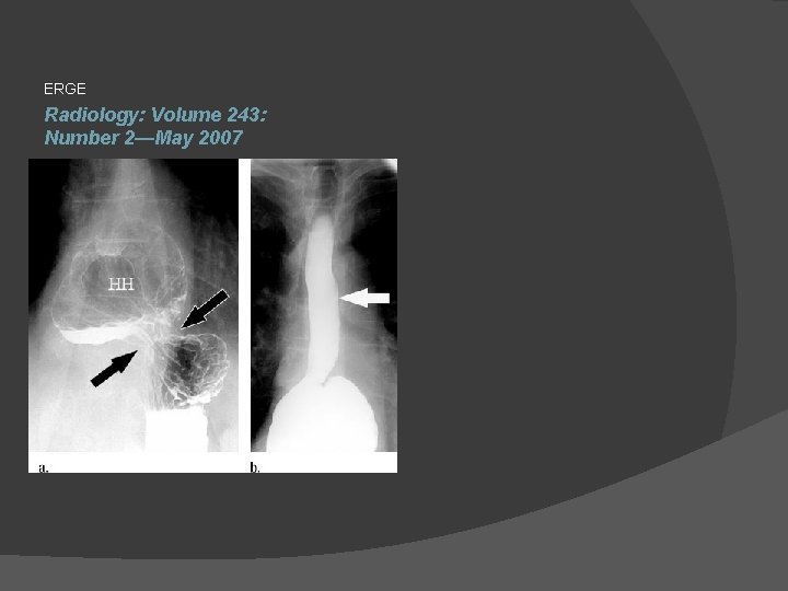 ERGE Radiology: Volume 243: Number 2—May 2007 
